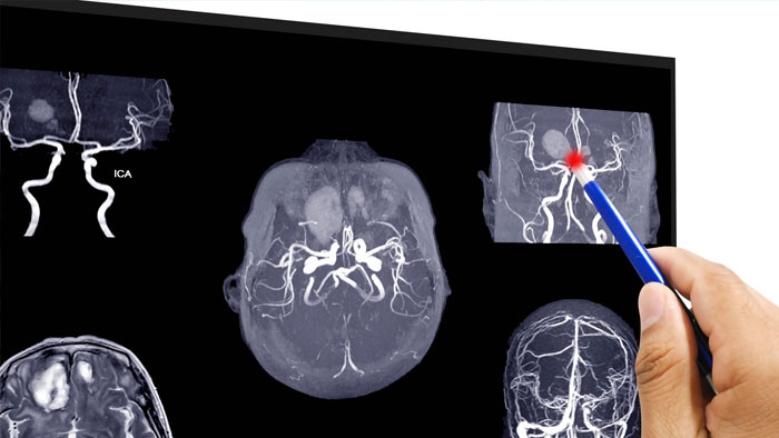 درمان‌ آنوریسم مغزی