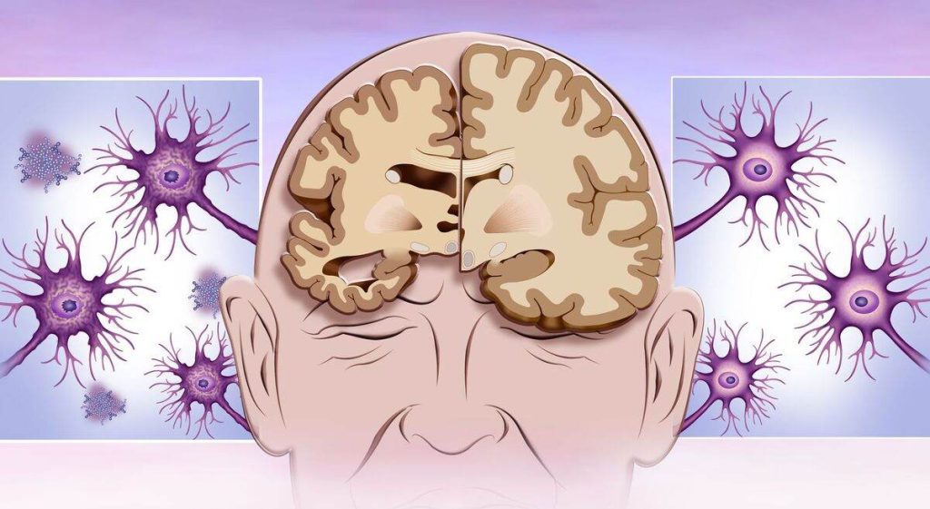 آلزایمر بعد از سکته مغزی